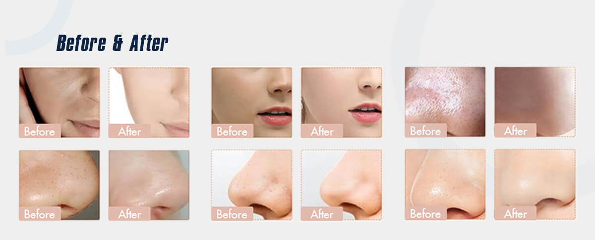 Dermabrasion Facial Skin Care Hydra Microdermabrasion Diamond Peel Machine 7.12 (5) 7.jpg