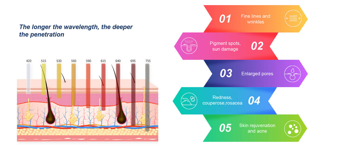 SHR IPL with filter skin rejuvenation pigment removal vein removal vascular removal SHE- (3).jpg