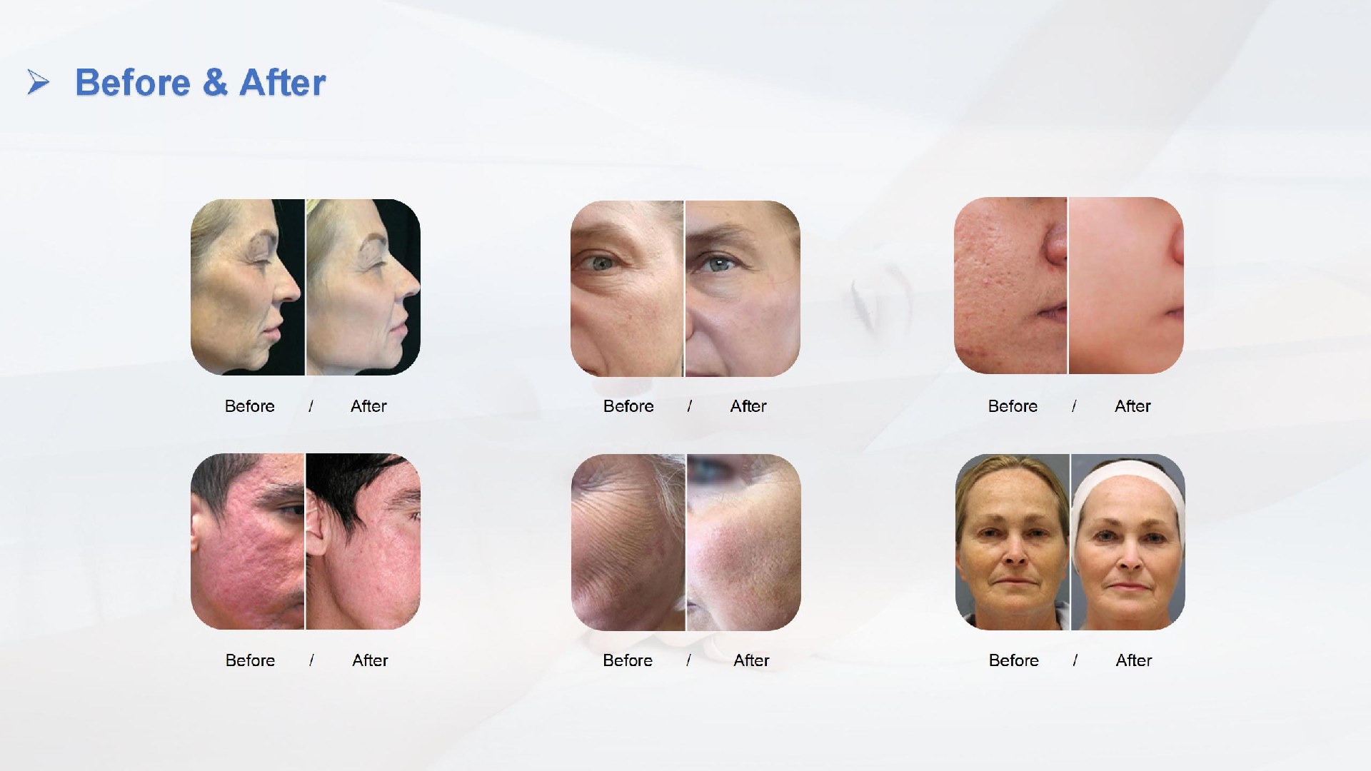 铒激光 Erbium laser  Beijing Sanhe - 副本_10.jpg